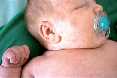 حذار من حساسية الحليب عند الطفل؟