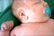 حذار من حساسية الحليب عند الطفل؟