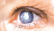 علاج شكل من أشكال العمى الوراثي في كلتا العينين!