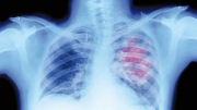 واحد من كل مائة مريض  بـ «كوفيد-19» يعاني من ثقب في الرّئة